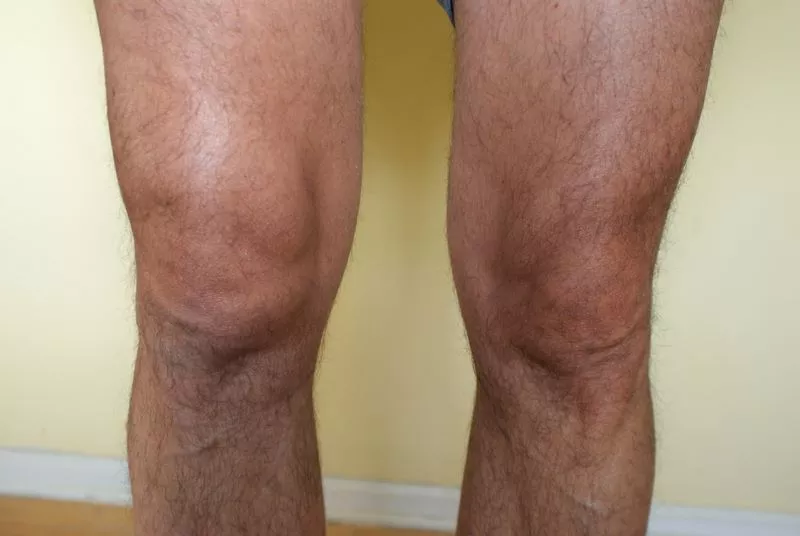 Knee osteoarthritis