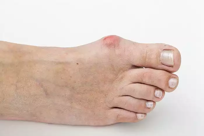 What’s the Deal With Bunions